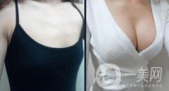 隆胸手術(shù)后多久恢復(fù)？術(shù)后注意事項有哪些