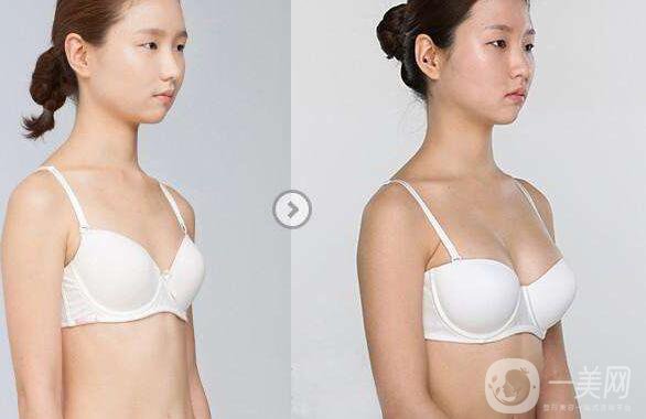 麥格,乳房假體隆胸,*果