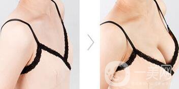 自體隆胸后多久可以上班？術(shù)后有哪些注意事項(xiàng)