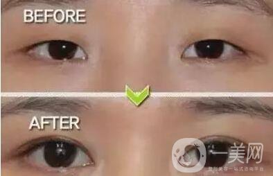 北京,開眼角,醫(yī)院