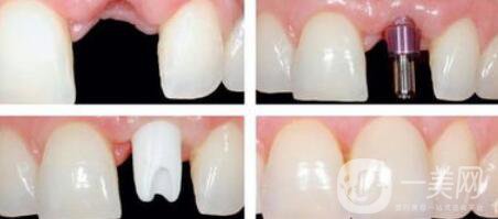 種植牙是怎么操作的？種植牙的過程