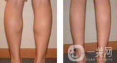 寧波射頻瘦小腿價格一般是多少錢