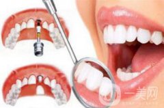 深圳種植牙手術(shù)價格大概是多少？