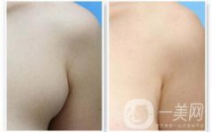 副乳是什么？副乳切除手術(shù)需要多久