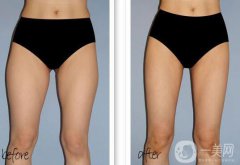 大腿吸脂多久恢復？大腿吸脂后遺癥有哪些