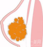 取出乳房奧美定果怎么樣？取出*嗎？