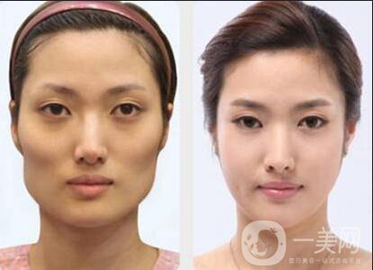 磨顴骨手術(shù)之后容易有后遺癥么？主要有哪些情況？