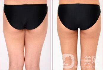 磨顴骨手術之后容易有后遺癥么？主要有哪些情況？