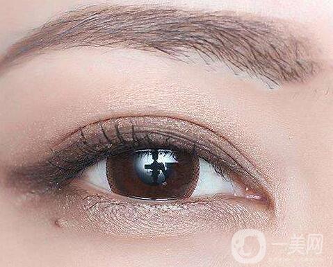 割雙眼皮術后注意事項有哪些？