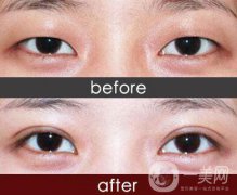 做完埋線雙眼皮手術需要注意什么