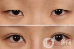 雙眼皮手術(shù)有哪些方法？做雙眼皮前要準(zhǔn)備什么