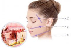 北京非手術(shù)面部提升大概需要多少錢?