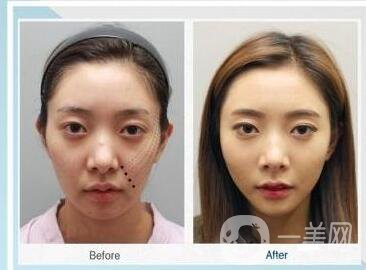 北京,非手術面部提升,大概需要多少錢