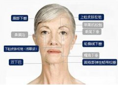 什么是面部提升?北京面部提升多少錢?