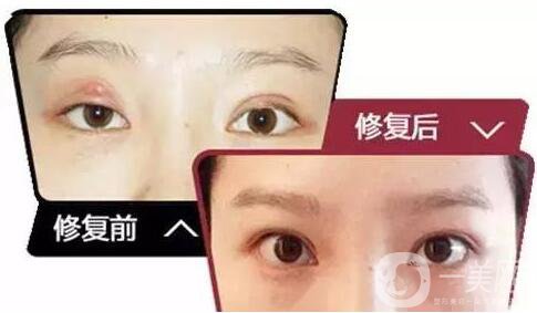 雙眼皮增生是什么樣子？