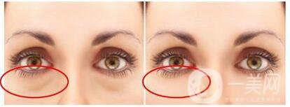 內(nèi)切祛眼袋失敗的原因 內(nèi)切祛眼袋后遺癥