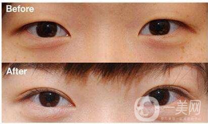 北京,開眼角,醫(yī)院