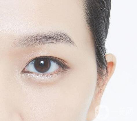 開眼角,適宜人群