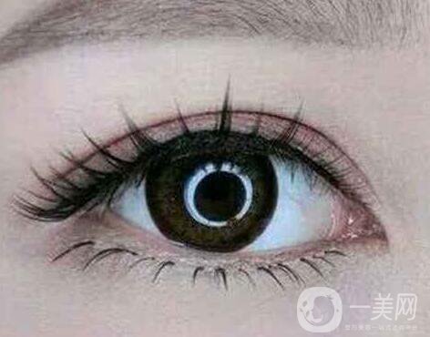 埋線雙眼皮之后禁口嗎？