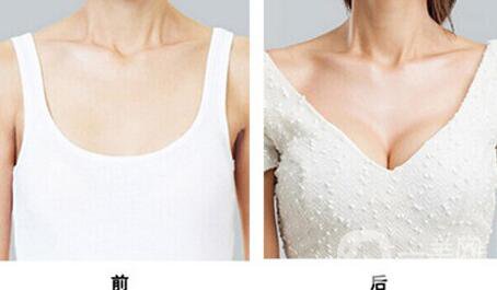 假體隆胸多久開始按摩？具體如何操作