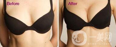 假體隆胸多久開始按摩？具體如何操作