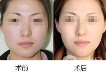去頰脂墊瘦臉術(shù)前注意事項有哪些