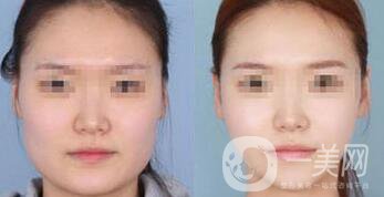 去頰脂墊瘦臉術(shù)前注意事項有哪些