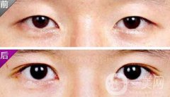 埋線雙眼皮之后禁忌有哪些？具體注意事項(xiàng)介紹