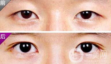 埋線雙眼皮之后禁忌有哪些？具體注意事項介紹