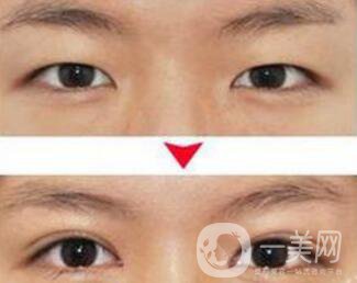 埋線雙眼皮之后禁忌有哪些？具體注意事項介紹