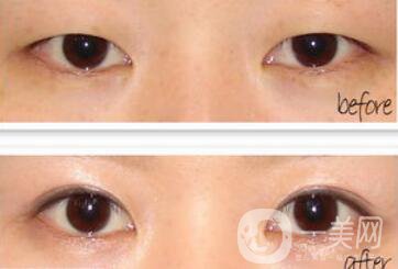 埋線雙眼皮之后禁忌有哪些？具體注意事項介紹