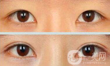 疤痕體質(zhì)能割雙眼皮嗎