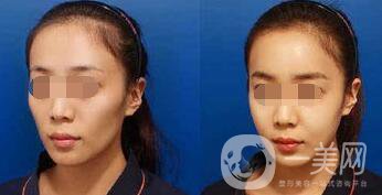 自體脂肪臉部填充可以做哪些部位