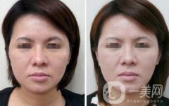 光子嫩膚適合多大年齡的人群