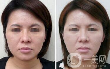 光子嫩膚適合多大年齡的人群