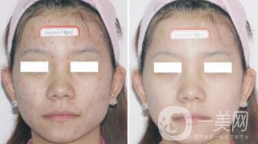 光子嫩膚適合多大年齡的人群