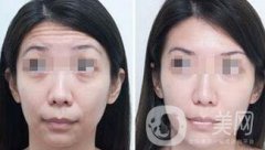 抬頭紋能消除嗎？用什么方法祛除抬頭紋