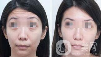 抬頭紋能消除嗎？用什么方法祛除抬頭紋