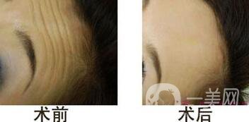 抬頭紋能消除嗎？用什么方法祛除抬頭紋