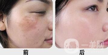 深圳做c6激光祛斑多少錢一次