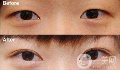 開(kāi)眼角,術(shù)后護(hù)理