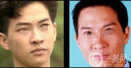 割雙眼皮術(shù)后的疤痕增生會消失嗎