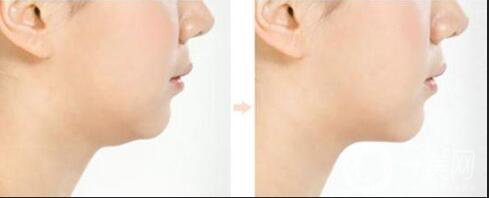 減雙下巴快捷*的方法是什么