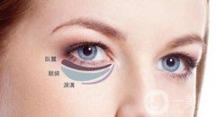 內(nèi)切祛眼袋術(shù)后護理主要有哪幾點？