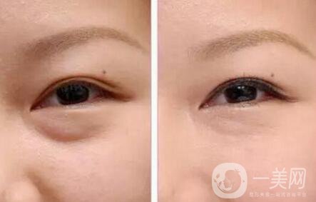 內(nèi)切祛眼袋術(shù)后護(hù)理主要有哪幾點(diǎn)？