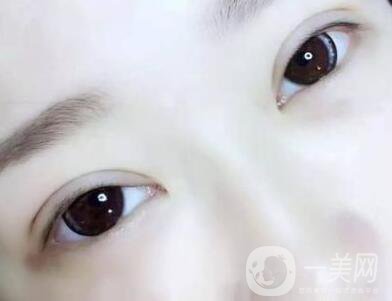 埋線后注意事項(xiàng)有哪些？