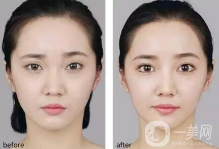 開外眼角術(shù)前注意事項主要有哪幾點？