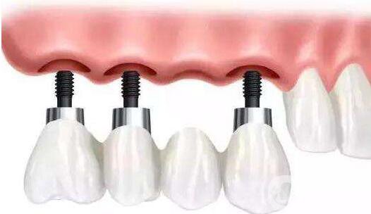 種植牙