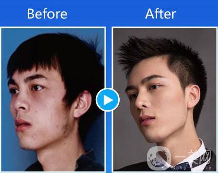 第二次隆鼻多久修復？隆鼻修復多久才可以做？