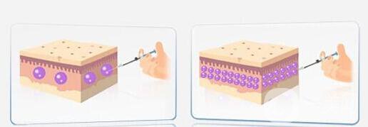 自體脂肪隆胸后多久可以恢復(fù)上班？